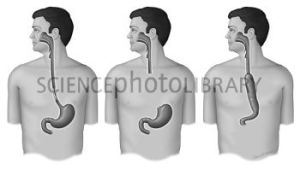 View showing esophagectomy procedure in three steps.